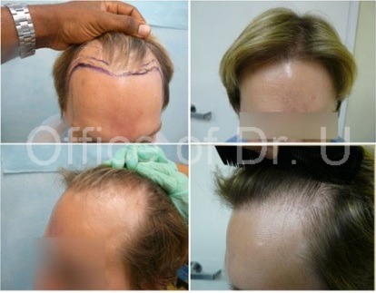 Follicular Unit Extraction Using 2500 Grafts ends comb overs