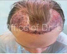 Scabs in recipient area immediately after 2500 grafts UGraft FUE hair restoration in Los Angeles by Dr U