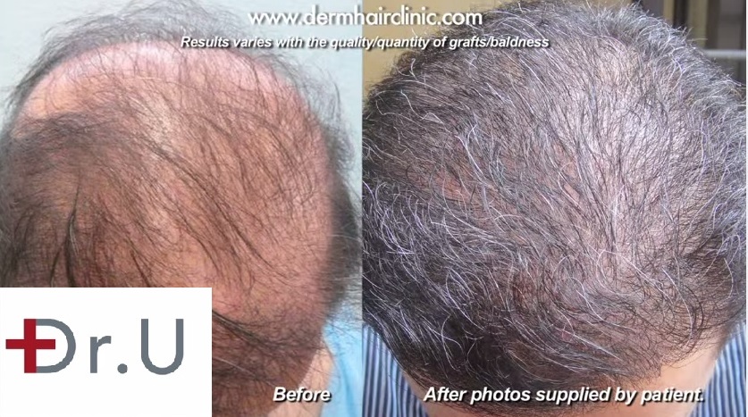 Top of Patient's Head|Comparison= Before & After Body Hair Transplant