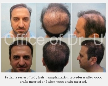 Dr Umar's Los Angeles Hair Restoration progression photo series Dr Umar's Los Angeles Hair Restoration progression photo series