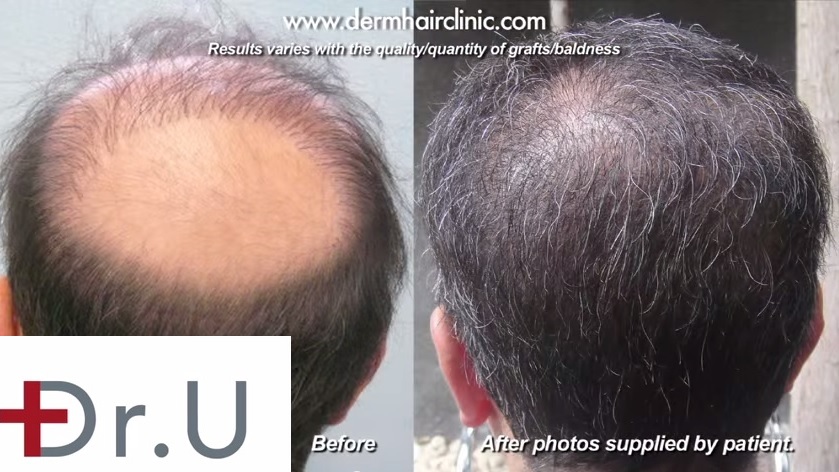 BHT Reversal of Crown Baldness