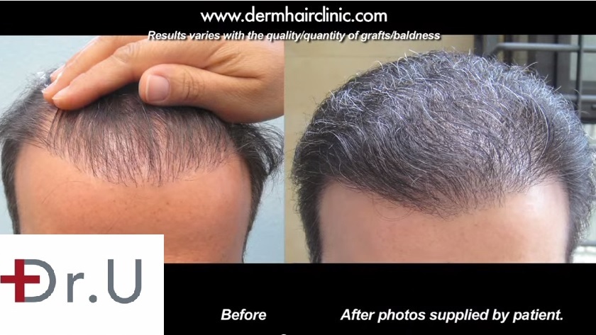 Hair Transplant Repair for Pluggy Hairline|Body Hair Grafts