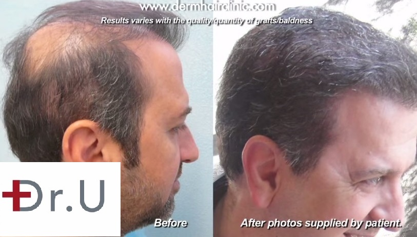 UGraft BHT Repair Results of a Dr U patient after surgery at his Los Angeles Clinic UGraft BHT Repair Results of a Dr U patient after surgery at his Los Angeles Clinic