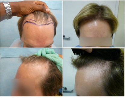 Hairline Restored using 2500 FUE Grafts 