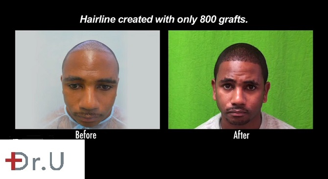 Patient's Hairline and Temples|Before & After His FUE Restoration