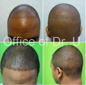 African American Advanced UGraft FUE Hair Transplant Using 1200 Grafts