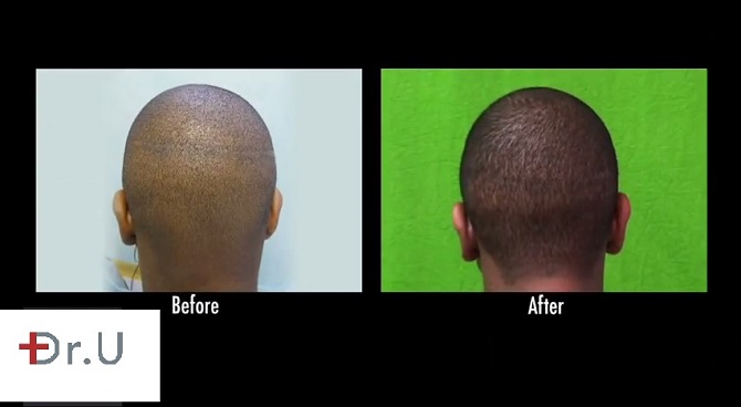 Linear Strip Scar Repair|Black Male Patient