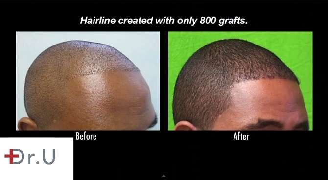 FUE Temple & Hairline Advancement|African American