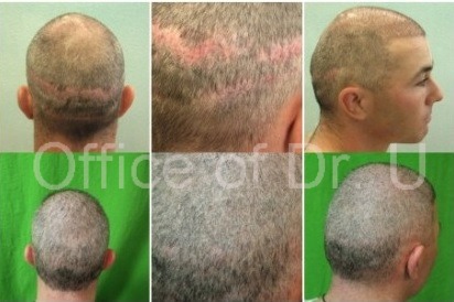 Strip surgery scar repair using UGraft follicular unit extraction at Dr U's Los Angeles clinic . After his procedure, he felt confident enough to wear a short buzz cut.