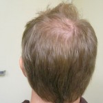 After Hairline and Crown FUE Hair Transplant Using 3500 grafts