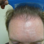 After Crown Hair Transplant with FUE 