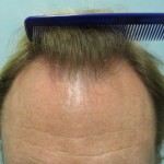 Before a Crown Hair Transplant 