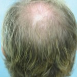 Back of Head Before Crown Hair Transplant 