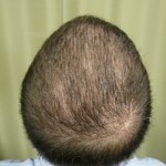 After UGraft FUE Hair Transplant Using 5000 grafts