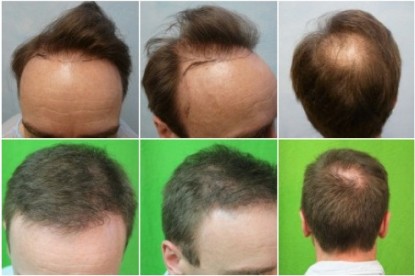 Repair of botched hair transplant results, corrective hair surgery