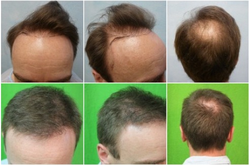 FUE Hair Restoration 3500 grafts – Hairline and Crown Hair Loss
