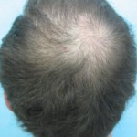 Before Picture of Hair Transplant with FUE 