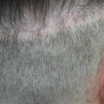 Before Picture of Strip Scar Repair with Beard Hair 