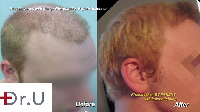 Body Hair Transplant|Temple Hair Restoration - Before & After