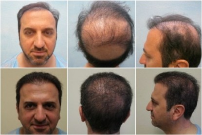 Bad Hair Surgery Correction With 9000 Body Hair Grafts, before and after pictures