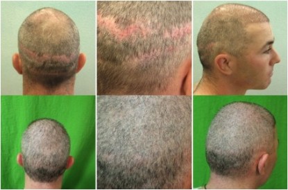 Strip Scar Before and After with FUE Technology 