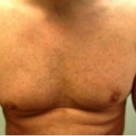 Figure 10a: After extraction of thousands of grafts from the chest.