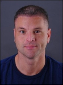 hair restoration 14 Figure 10c: After BHT repair with chest hair by Dr. Umar.