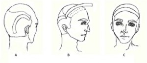 Figure 2: A) Shows where the temporoparieto-occipital flap is cut. B) Shows the excised flap. C) Shows the final placement of the flap.
