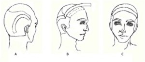 hair restoration 2 Figure 2: A) Shows where the temporoparieto-occipital flap is cut. B) Shows the excised flap. C) Shows the final placement of the flap.