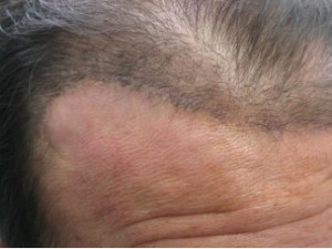 Unnatural hairline of a flap Figure 2a: Unnatural hairline of a flap.