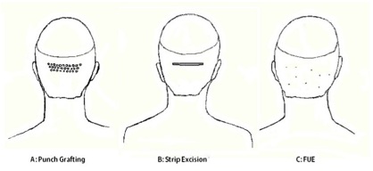 hair restoration 4 Figure 3: Schematic representations of methods of graft creation/extraction.