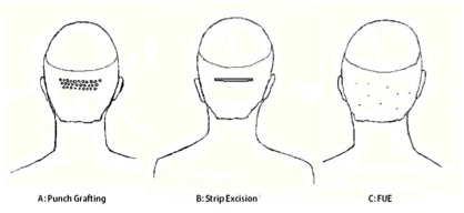 Figure 3: Schematic representations of methods of graft creation/extraction.