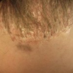 Figure 4: Dolls hair of punch graft method of hair transplant.