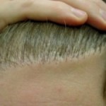 Figure 6: Pluggy hairline from minigraft method of hair transplantation.