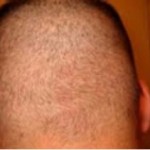 hair restoration 9 Figure 8: FUE donor healing.