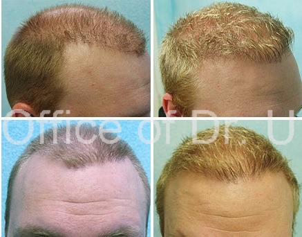 Before and after Hair Restoration Repair Using UGraft - Hairline asymmetry repair