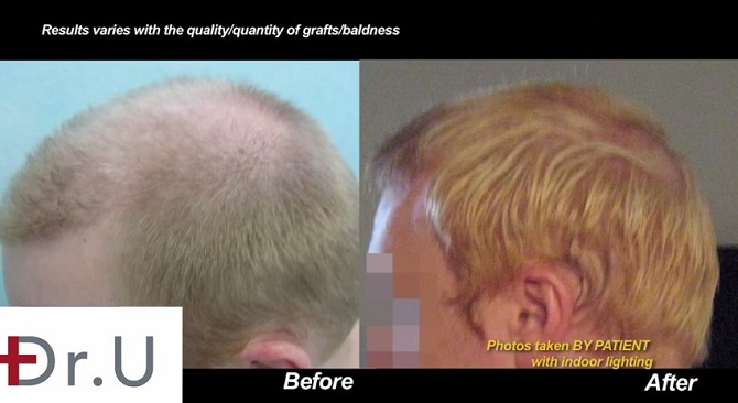 Before and After Profile View| Body Hair Transplant Results