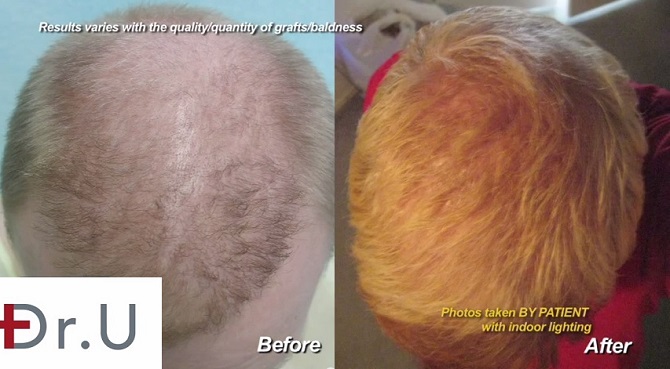 Improved Density of Scalp|Body Hair Insertions