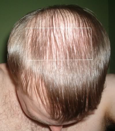Marked area before BHT| Surgical treatment of hair loss Toppik And Other Hair Loss Concealers