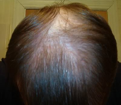 Toppik-like effect after BHT Toppik And Other Hair Loss Concealers