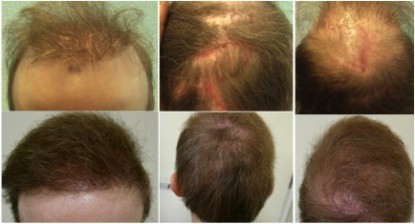 Results of 36-year-old Body hair transplant BHT patient featured in Dr. Umar’s article