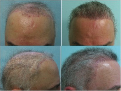 Front and side views of the patient before and after body hair to head transplant Front and side views of the patient before and after body hair to head transplant