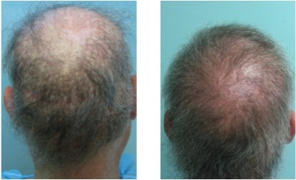 Rear views of before and after this patient's body hair to scalp transplant Rear views of before and after this patient's body hair to scalp transplant.