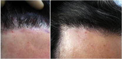 Close view of the hairline before and after body hair to head transplant