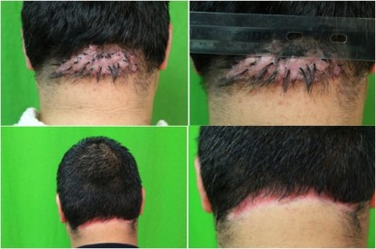 removal of AKN tumor| back of head razor bumps surgery| male patient|straight hair removal of AKN tumor