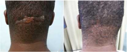 Back of head razor bumps before and after Surgical excision
