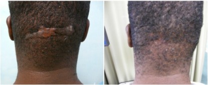 back of head razor bumps before and after surgical excision Back of head razor bumps before and after Surgical excision