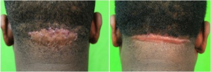 Back of head razor bumps: The who, when, and how.