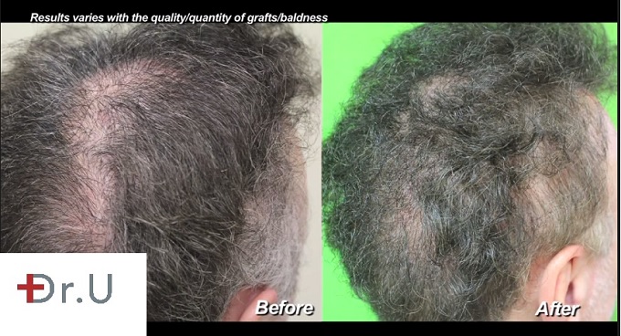 Hair Transplant Repair with facial hair to head transplant with 3000 Ugrafts