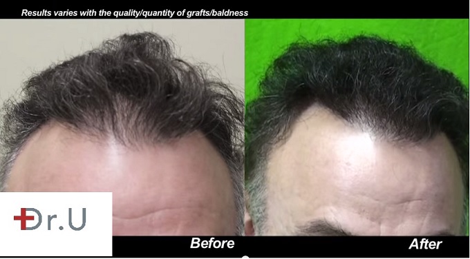 Hairline Restoration| facial hair to head transplant with 3000 Ugrafts